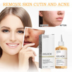 Glycolic Acid 7% Toning Solution Ordinary Acne Remover