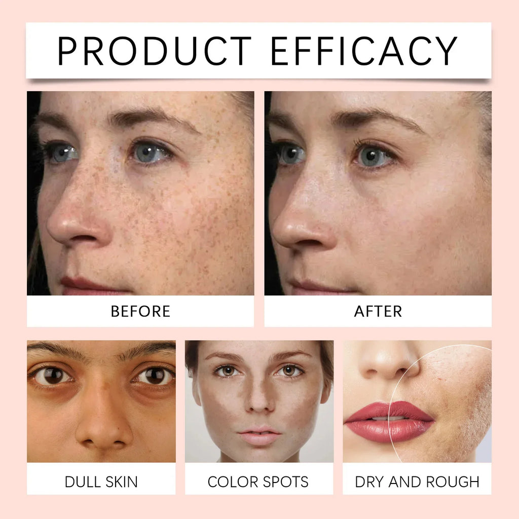 Kojic Acid Freckle Removing Whitening Essence Fade Pigmentation Melasma Dark Spots Corrector Repair Serum Korean Skin Care