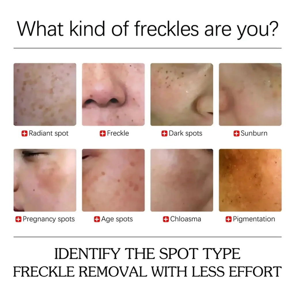 Kojic Acid Freckle Removing Whitening Essence Fade Pigmentation Melasma Dark Spots Corrector Repair Serum Korean Skin Care