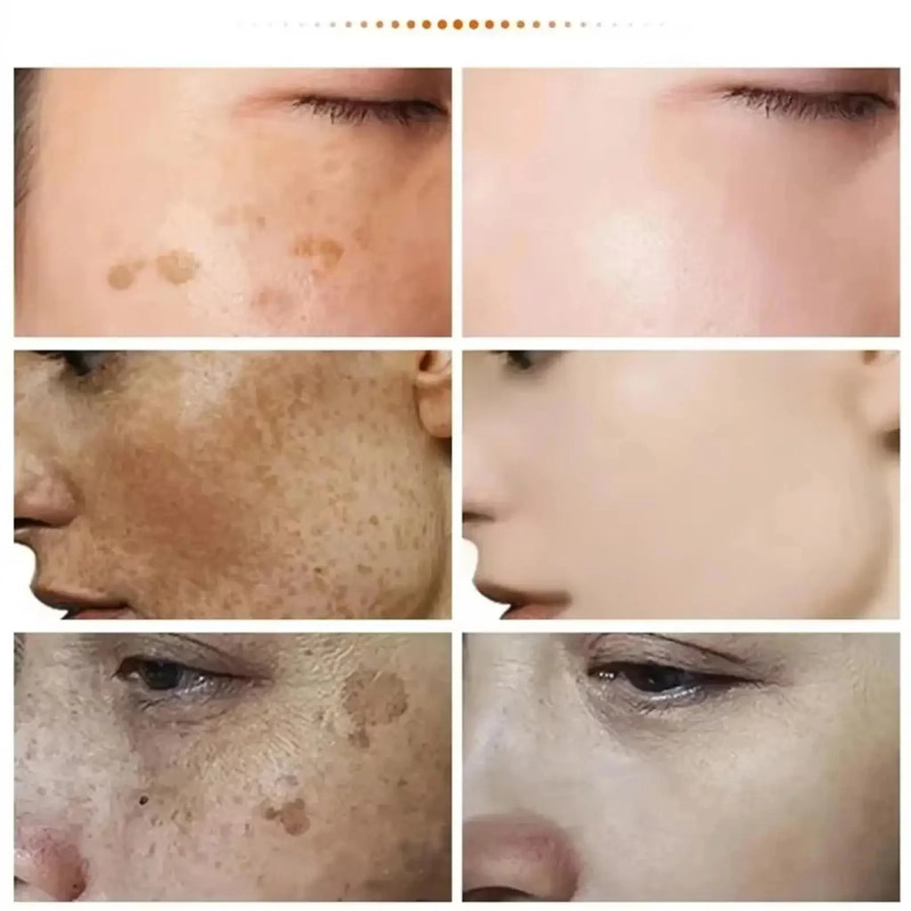 Kojic Acid Freckle Removing Whitening Essence Fade Pigmentation Melasma Dark Spots Corrector Repair Serum Korean Skin Care
