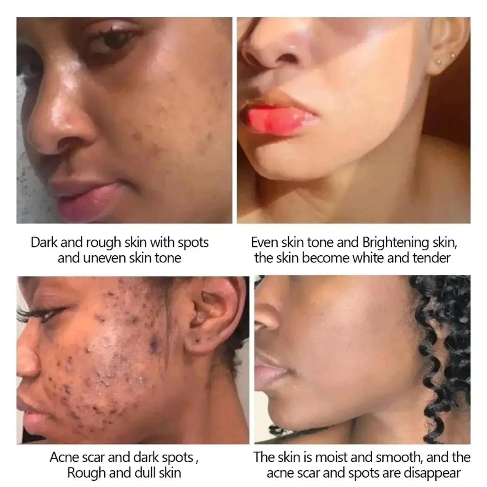 Kojic Acid Freckle Removing Whitening Essence Fade Pigmentation Melasma Dark Spots Corrector Repair Serum Korean Skin Care